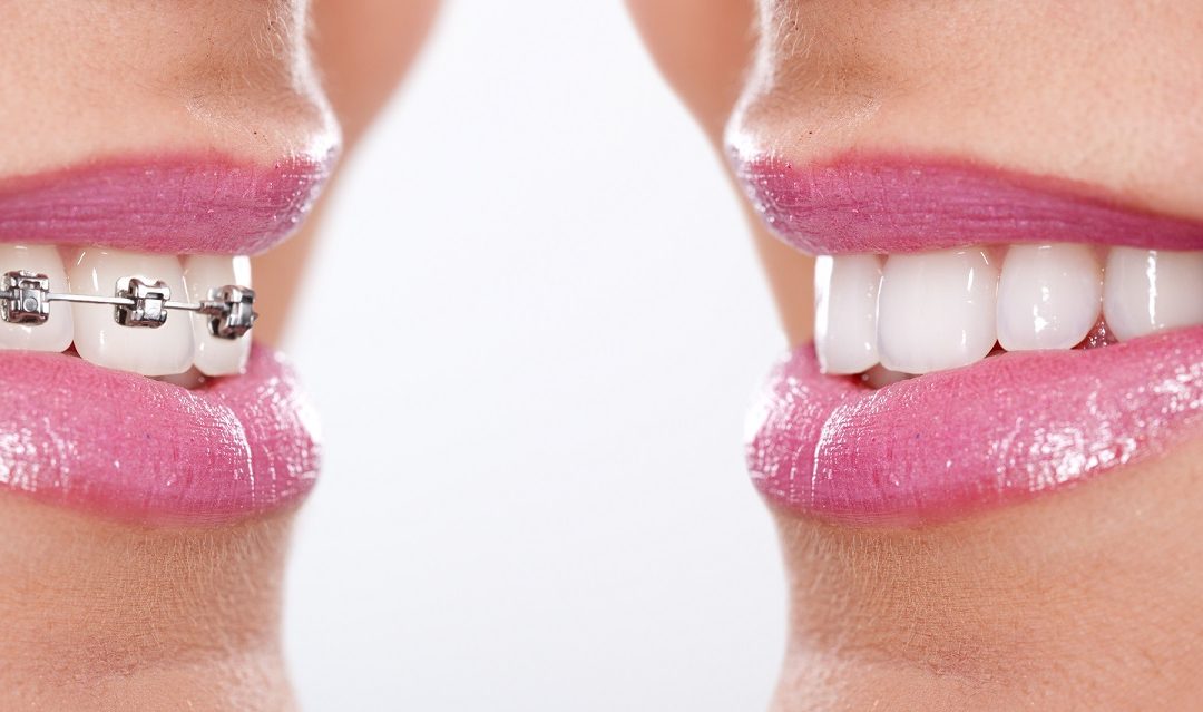 Czy aparat ortodontyczny zmienia rysy twarzy?