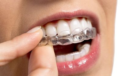 Wady ortodontyczne. Wady ortodontyczne i możliwości leczenia Invisalign.