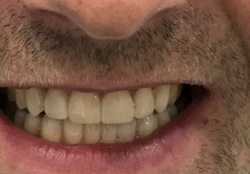 Połączenie ortodoncji przy zastosowaniu nakładek Invisalign® i protetyki daje spektakularne efekty!