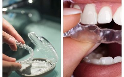 Higiena jamy ustnej w trakcie leczenia Invisalign®