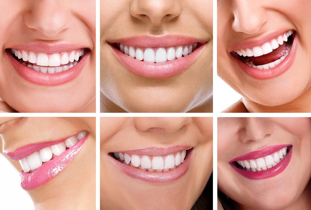 Koszty leczenia ortodontycznego – dlaczego warto postawić na nakładki Invisalign®