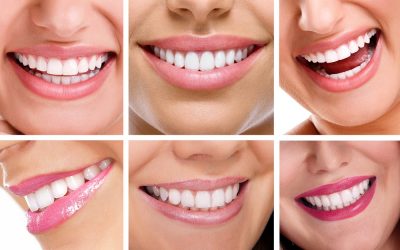 Koszty leczenia ortodontycznego – dlaczego warto postawić na nakładki Invisalign®