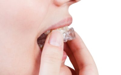 Invisalign® vs Clear Aligner ®– dlaczego Invisalign® wypada lepiej w tym porównaniu?