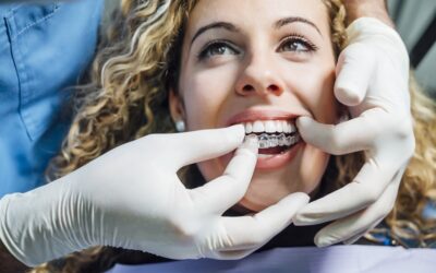 Nakładkowe aparaty ortodontyczne – z czego możemy skorzystać w Polsce?