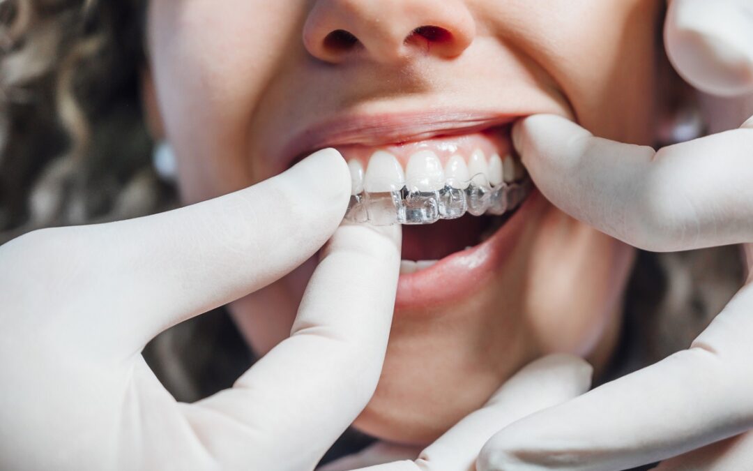 Aparat nakładkowy – czym jest i kiedy się stosuje?