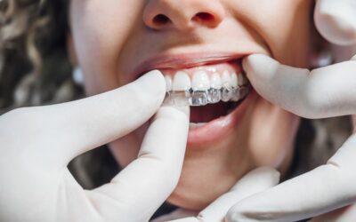 Aparat nakładkowy – czym jest i kiedy się stosuje?