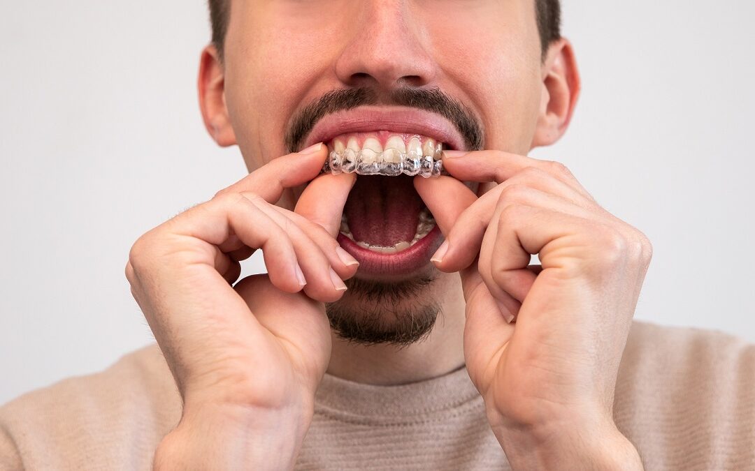 Czy Invisalign® rzeczywiście działa? Na czym polega ta metoda?