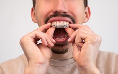 Czy Invisalign® rzeczywiście działa? Na czym polega ta metoda?