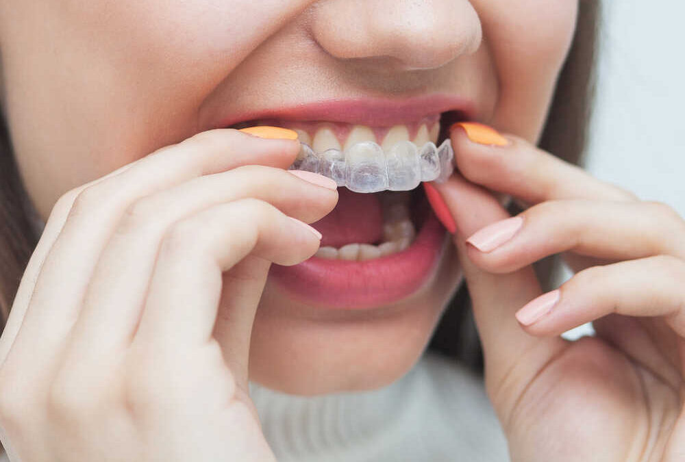 Invisalign® a skutki uboczne – czy jakieś istnieją?