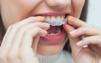 Invisalign® a skutki uboczne – czy jakieś istnieją?