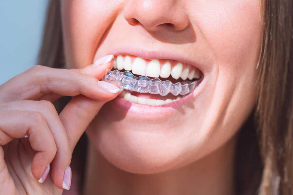 Kobieta zakładka nakładki Invisalign na zęby