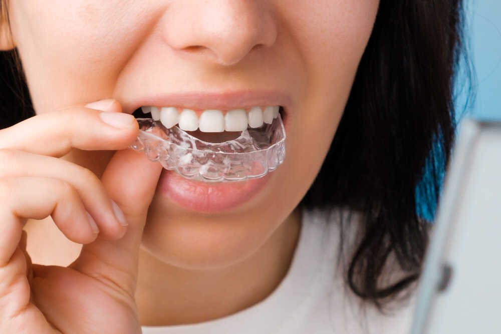 Uśmiechnięta kobieta zakłada nakładki Invisalign na zęby